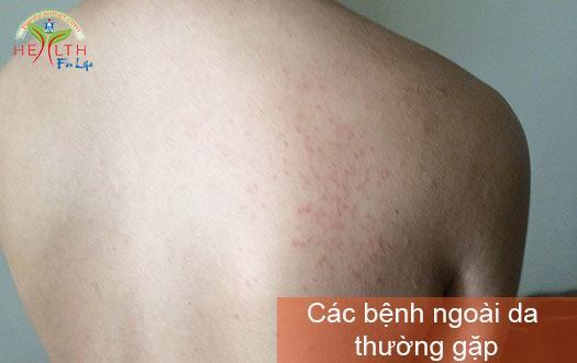 Một số bệnh ngoài da thường gặp vào mùa hè