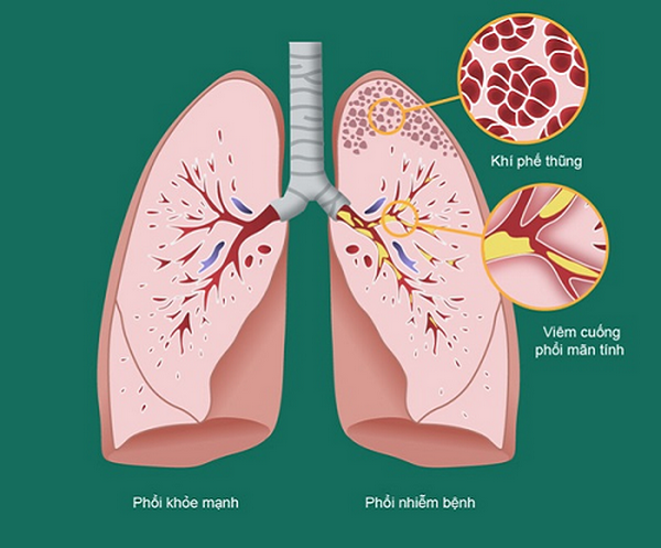 Tìm ra căn nguyên gây bệnh viêm đường hô hấp mạn tính